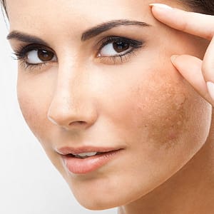 Melasma / Reprodução internet