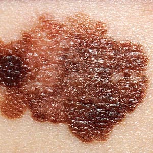 Câncer de pele - foto pelo National Cancer Institute