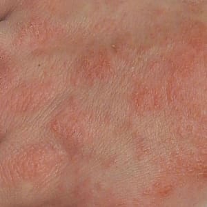 Dermatite - foto pelo Dr. James Heilman