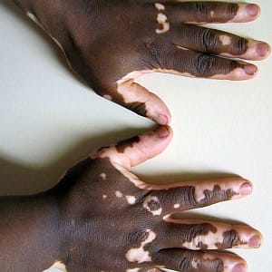 Vitiligo - foto pelo Dr. James Heilman